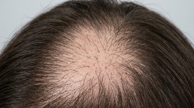 Alopecia causas y tratamiento